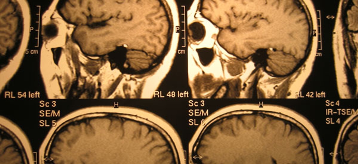 Afbeelding van Prostaatkanker beste opgespoord met MRI