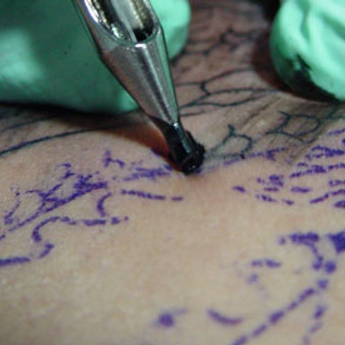 Afbeelding van VUmc opent tattoopoli voor verwijderen tattoos