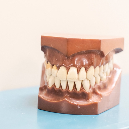 Orthodontisten waarschuwen voor trend doe-het-zelfbeugels
