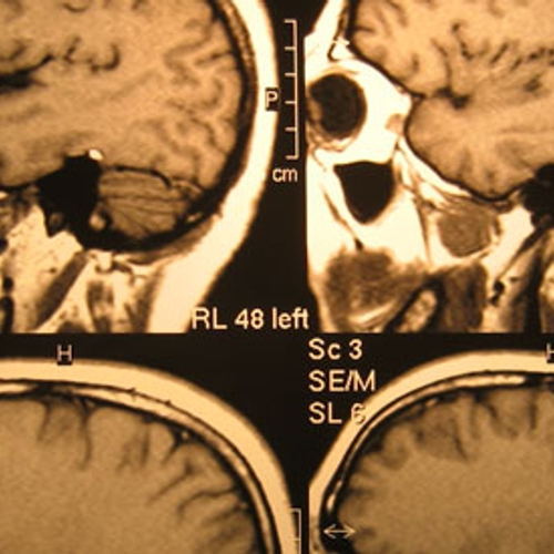 MRI-veilige Neurostimulator