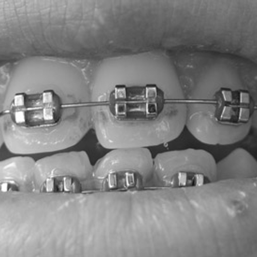 NZA: Orthodontisten moeten goedkoper